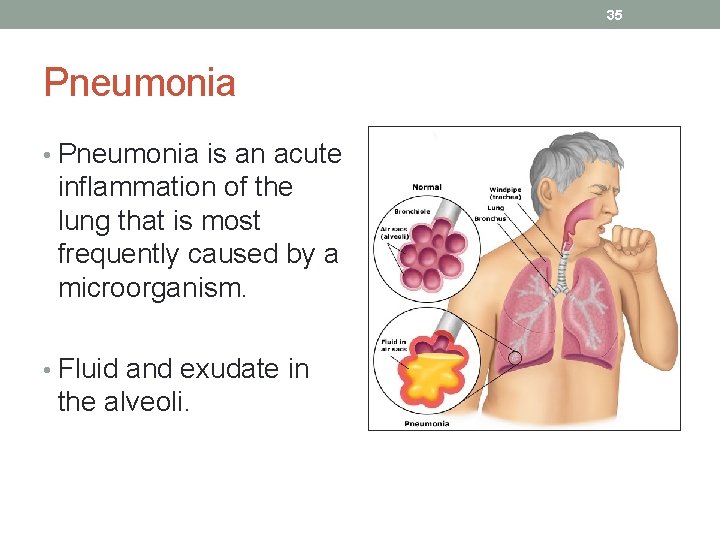 35 Pneumonia • Pneumonia is an acute inflammation of the lung that is most