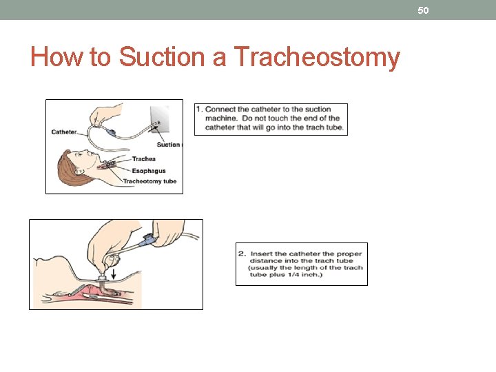 50 How to Suction a Tracheostomy 