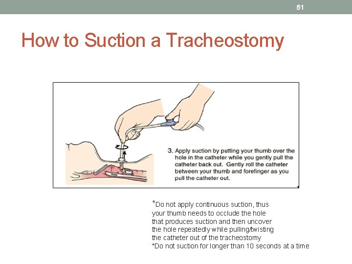 51 How to Suction a Tracheostomy *Do not apply continuous suction, thus your thumb