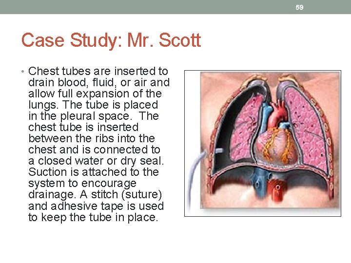 59 Case Study: Mr. Scott • Chest tubes are inserted to drain blood, fluid,