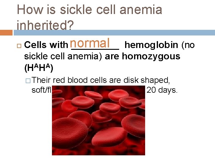 How is sickle cell anemia inherited? Cells with normal _____ hemoglobin (no sickle cell