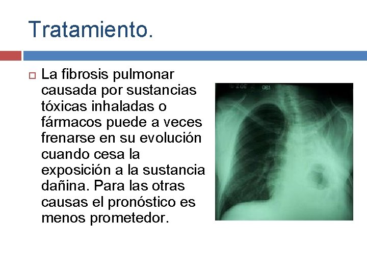 Tratamiento. La fibrosis pulmonar causada por sustancias tóxicas inhaladas o fármacos puede a veces