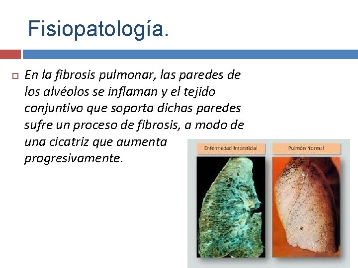 Fisiopatología. En la fibrosis pulmonar, las paredes de los alvéolos se inflaman y el