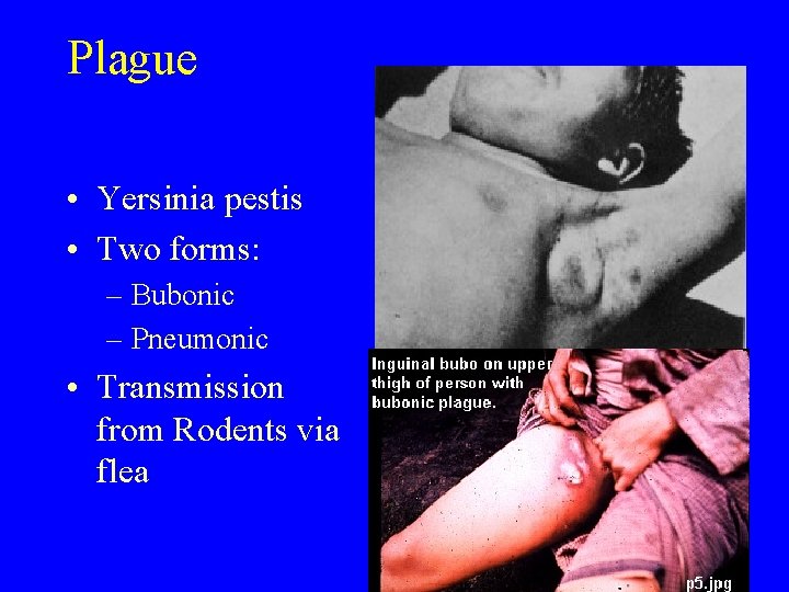 Plague • Yersinia pestis • Two forms: – Bubonic – Pneumonic • Transmission from