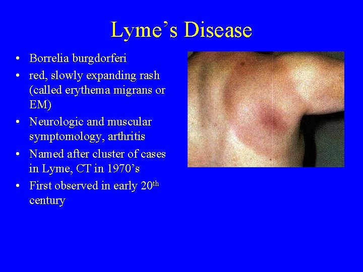 Lyme’s Disease • Borrelia burgdorferi • red, slowly expanding rash (called erythema migrans or