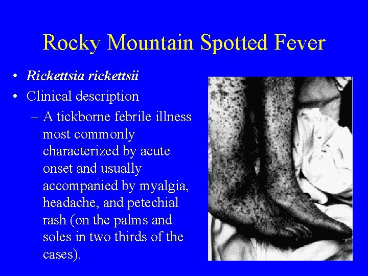 Rocky Mountain Spotted Fever • Rickettsia rickettsii • Clinical description – A tickborne febrile
