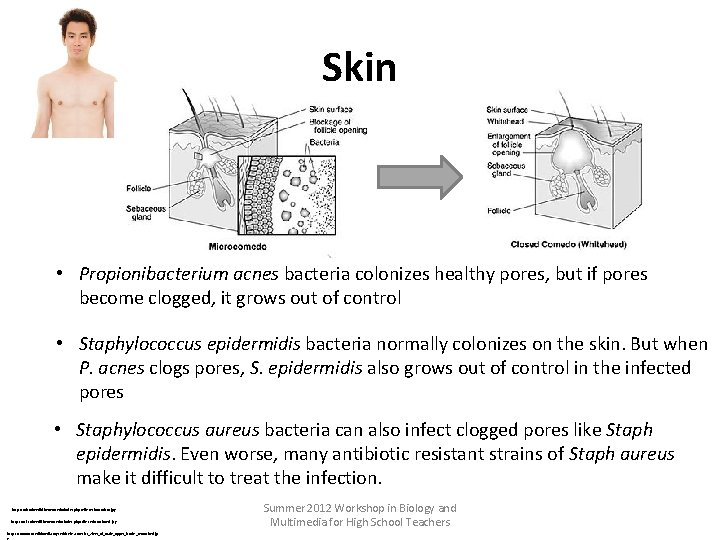 Skin • Propionibacterium acnes bacteria colonizes healthy pores, but if pores become clogged, it