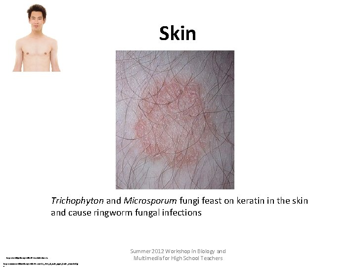 Skin Trichophyton and Microsporum fungi feast on keratin in the skin and cause ringworm