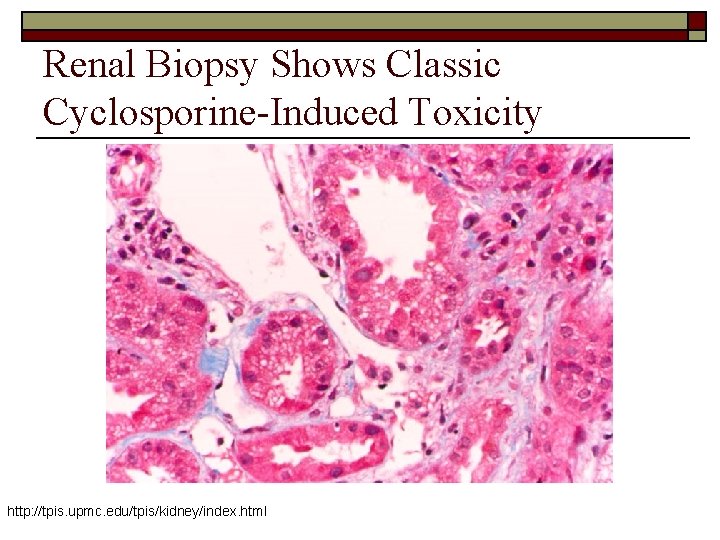 Renal Biopsy Shows Classic Cyclosporine-Induced Toxicity http: //tpis. upmc. edu/tpis/kidney/index. html 