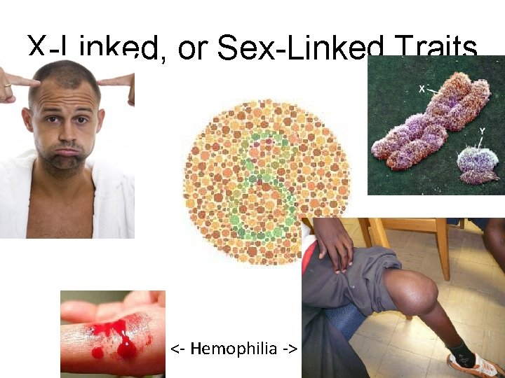 X-Linked, or Sex-Linked Traits <- Hemophilia -> 