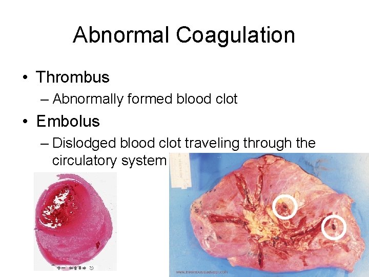 Abnormal Coagulation • Thrombus – Abnormally formed blood clot • Embolus – Dislodged blood