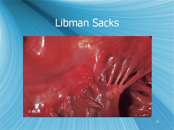 Libman Sacks 15 