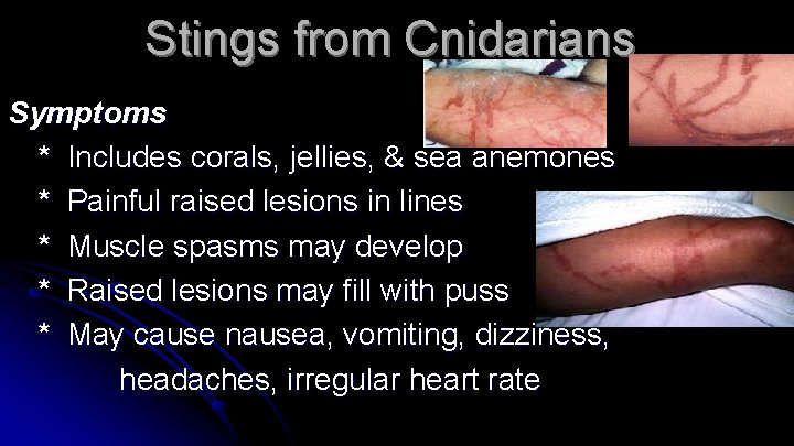 Stings from Cnidarians Symptoms * Includes corals, jellies, & sea anemones * Painful raised
