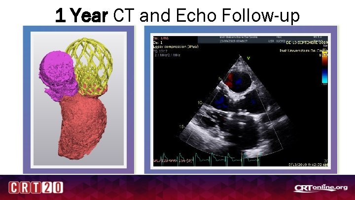 1 Year CT and Echo Follow-up 