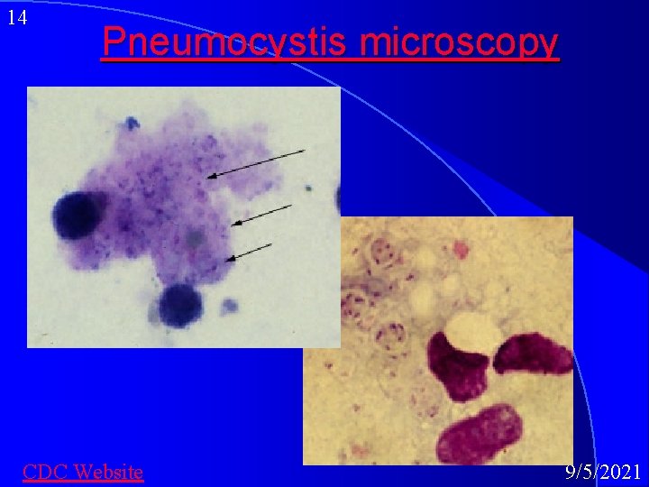 14 Pneumocystis microscopy CDC Website 9/5/2021 