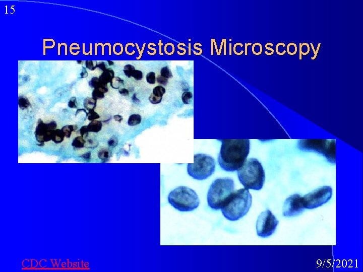 15 Pneumocystosis Microscopy CDC Website 9/5/2021 