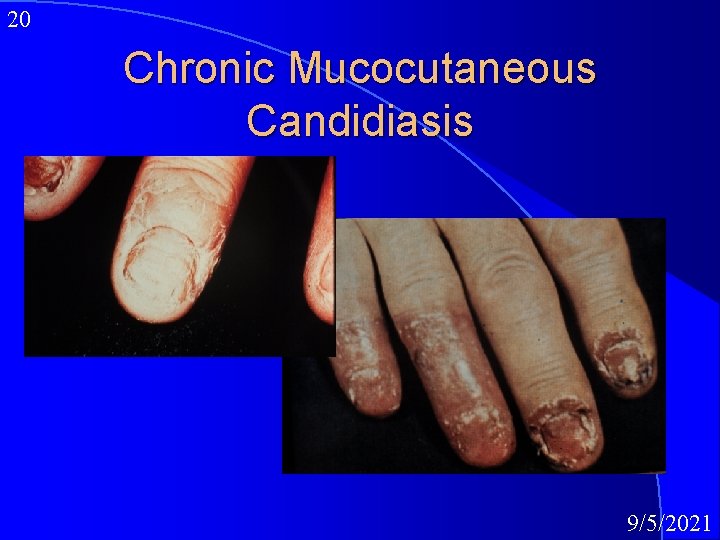 20 Chronic Mucocutaneous Candidiasis 9/5/2021 