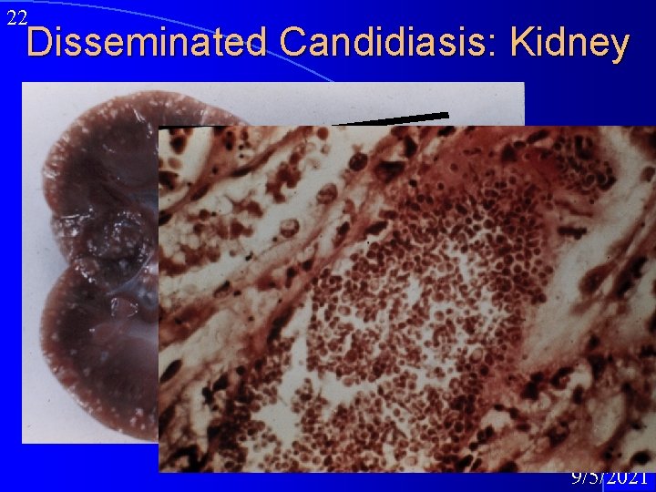 22 Disseminated Candidiasis: Kidney 9/5/2021 