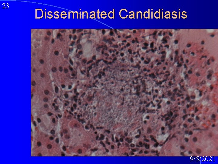 23 Disseminated Candidiasis 9/5/2021 