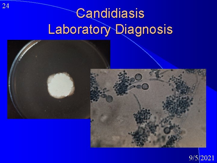 24 Candidiasis Laboratory Diagnosis 9/5/2021 