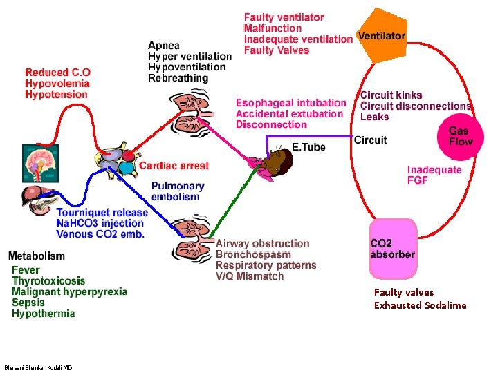 Faulty valves Exhausted Sodalime Bhavani Shankar Kodali MD 