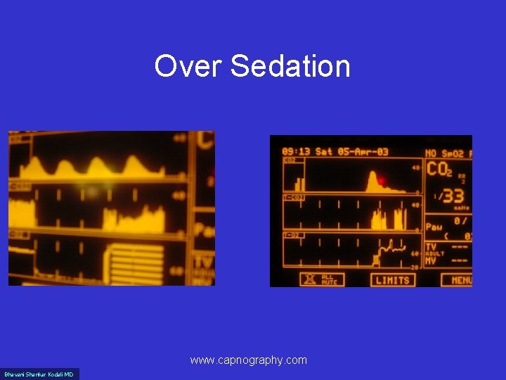 Over Sedation www. capnography. com Bhavani Shankar Kodali MD 