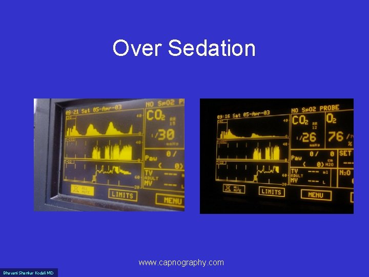 Over Sedation www. capnography. com Bhavani Shankar Kodali MD 