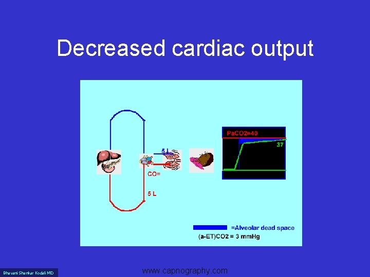 Decreased cardiac output Bhavani Shankar Kodali MD www. capnography. com 