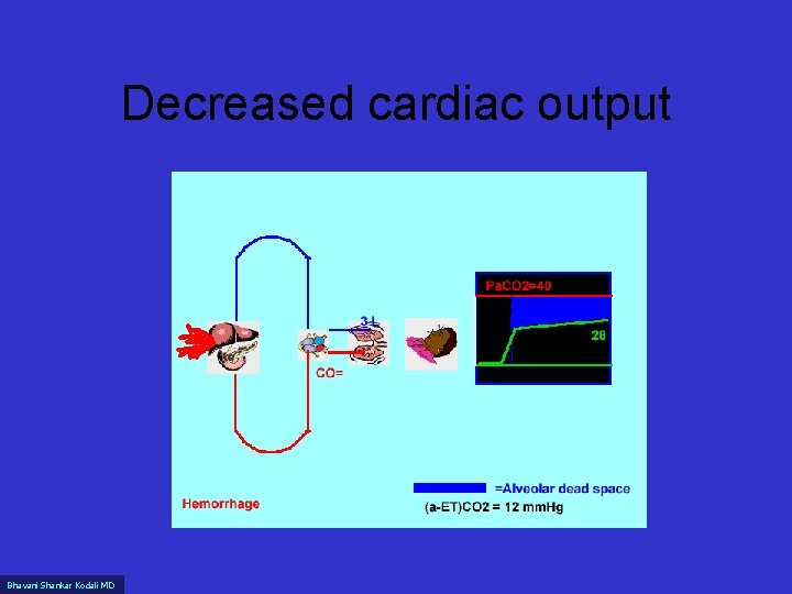 Decreased cardiac output Bhavani Shankar Kodali MD 