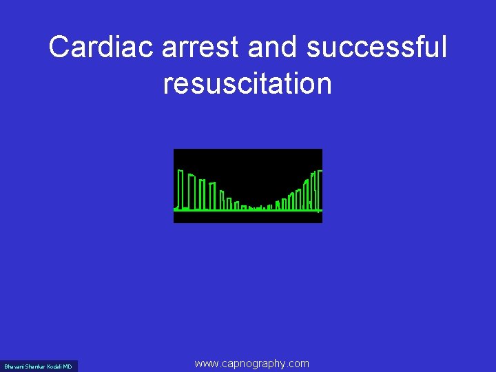 Cardiac arrest and successful resuscitation Bhavani Shankar Kodali MD www. capnography. com 