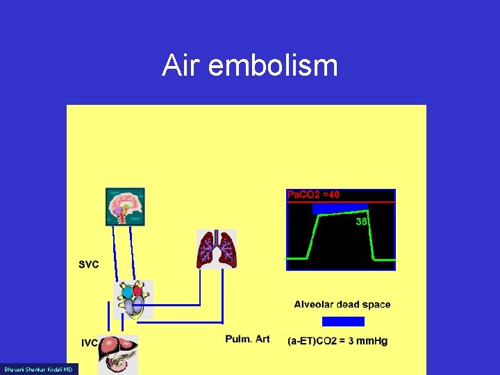 Air embolism Bhavani Shankar Kodali MD www. capnography. com 