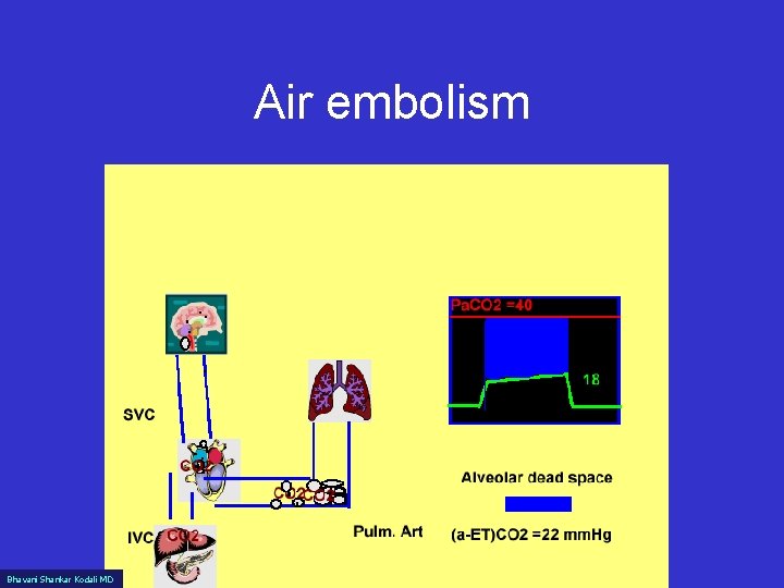 Air embolism Bhavani Shankar Kodali MD 