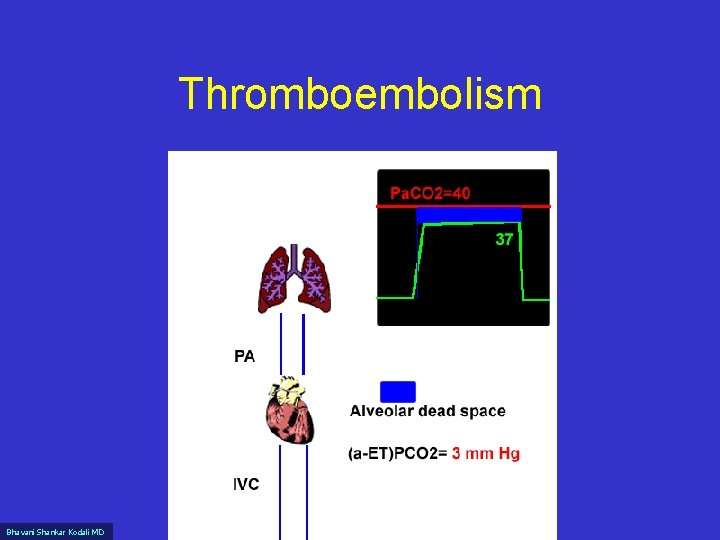 Thromboembolism Bhavani Shankar Kodali MD www. capnography. com 