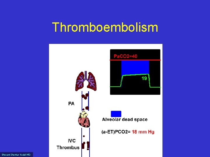 Thromboembolism Bhavani Shankar Kodali MD 