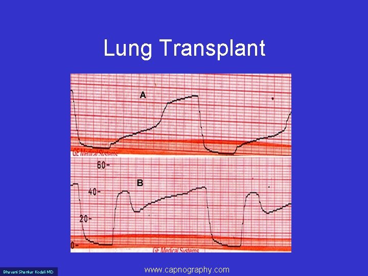 Lung Transplant Bhavani Shankar Kodali MD www. capnography. com 