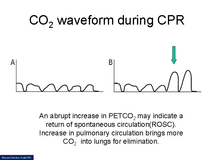 CO 2 waveform during CPR A B An abrupt increase in PETCO 2 may