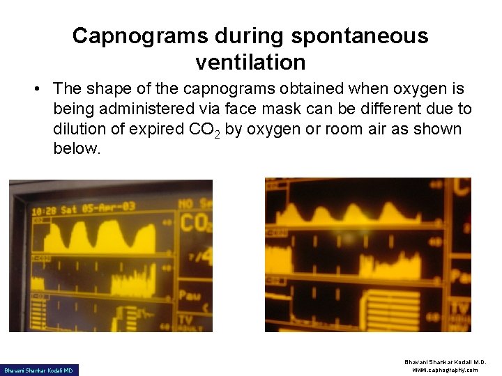 Capnograms during spontaneous ventilation • The shape of the capnograms obtained when oxygen is