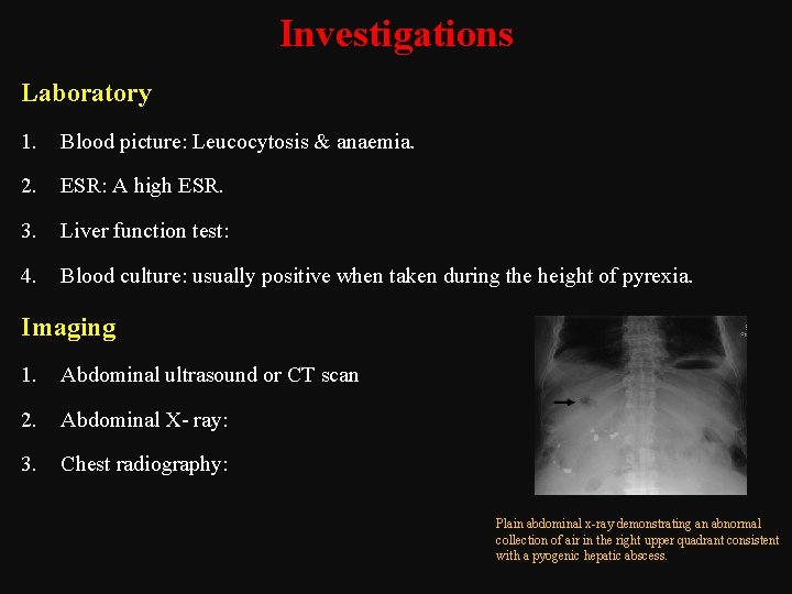 Investigations Laboratory 1. Blood picture: Leucocytosis & anaemia. 2. ESR: A high ESR. 3.