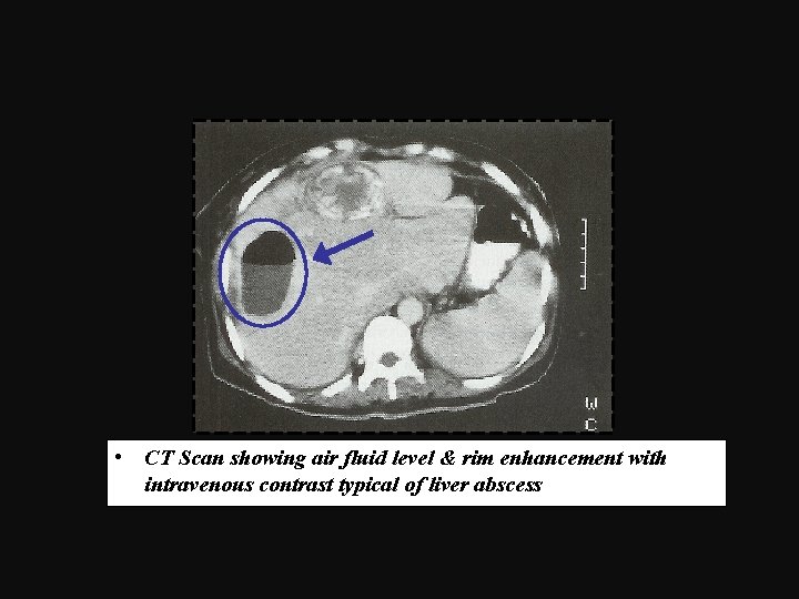  • CT Scan showing air fluid level & rim enhancement with intravenous contrast