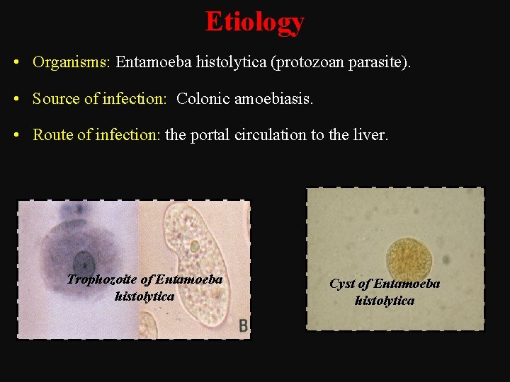 Etiology • Organisms: Entamoeba histolytica (protozoan parasite). • Source of infection: Colonic amoebiasis. •