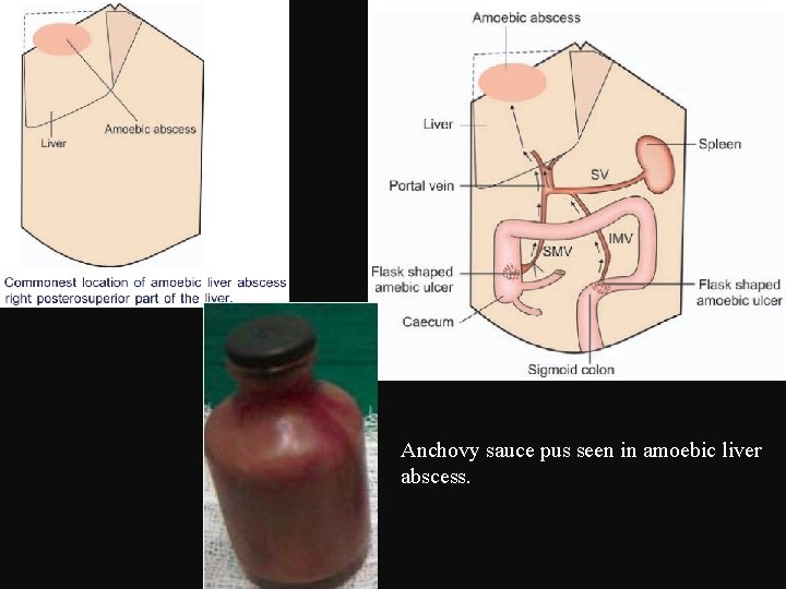 Anchovy sauce pus seen in amoebic liver abscess. 