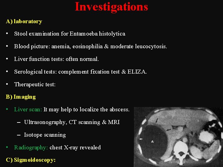 Investigations A) laboratory • Stool examination for Entamoeba histolytica • Blood picture: anemia, eosinophilia