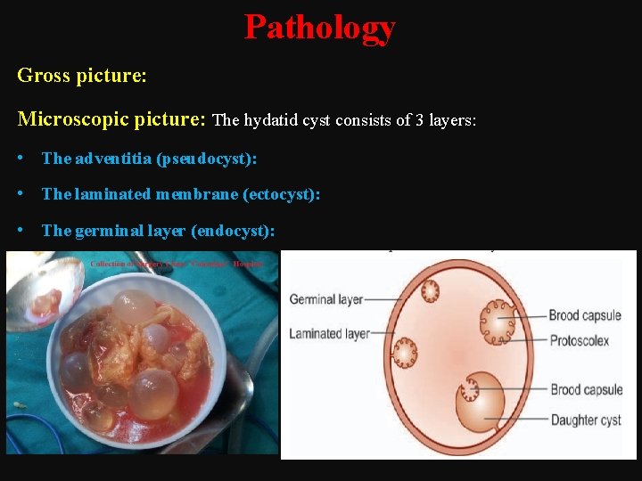 Pathology Gross picture: Microscopic picture: The hydatid cyst consists of 3 layers: • The