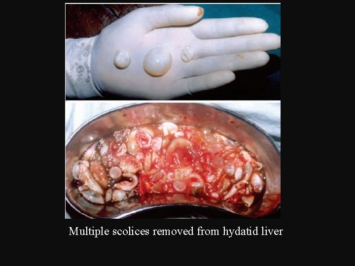 Multiple scolices removed from hydatid liver 