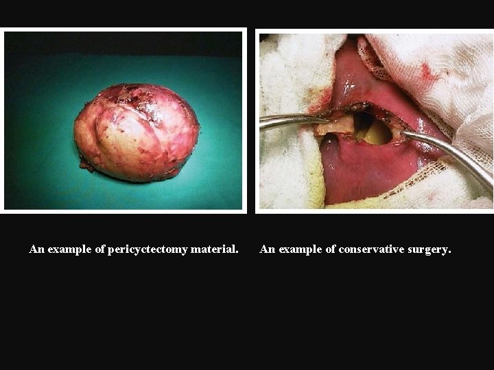 An example of pericyctectomy material. An example of conservative surgery. 