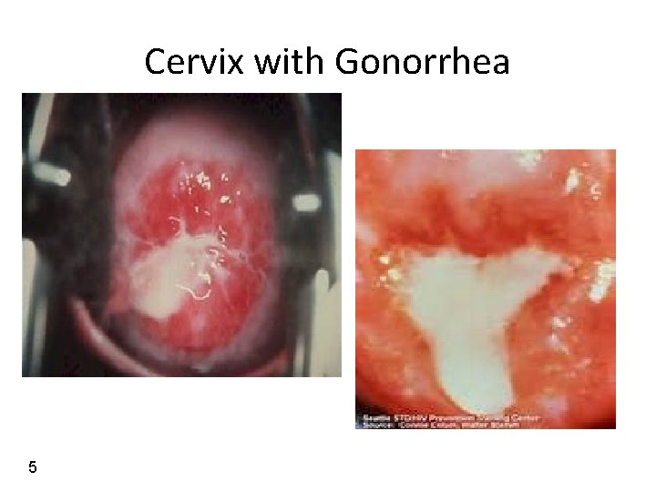 Cervix with Gonorrhea 5 