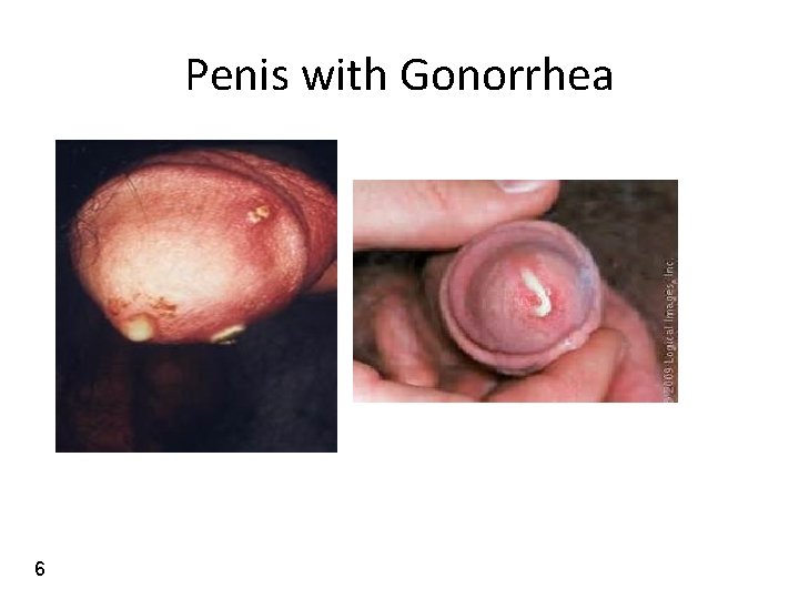 Penis with Gonorrhea 6 