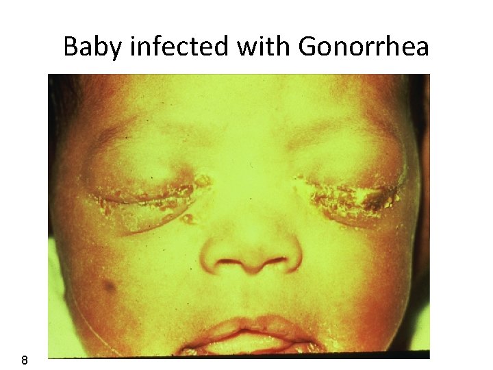 Baby infected with Gonorrhea 8 