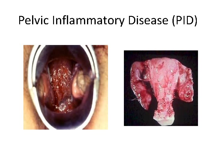 Pelvic Inflammatory Disease (PID) 