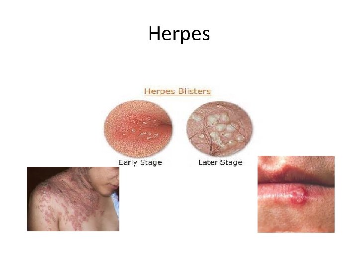 Herpes 